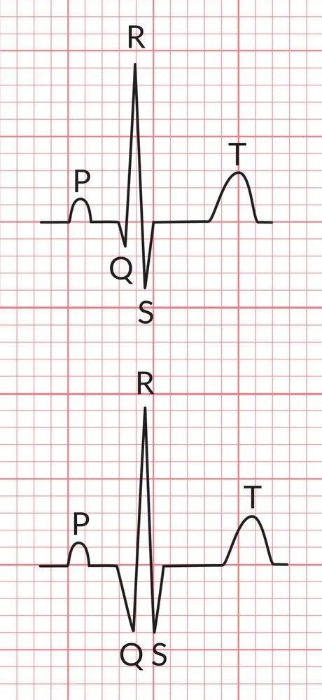 Top: a normal Q wave, small and narrow. Bottom: a pathological Q wave, at least one small box (40 ms) wide and deep relative to the R wave.