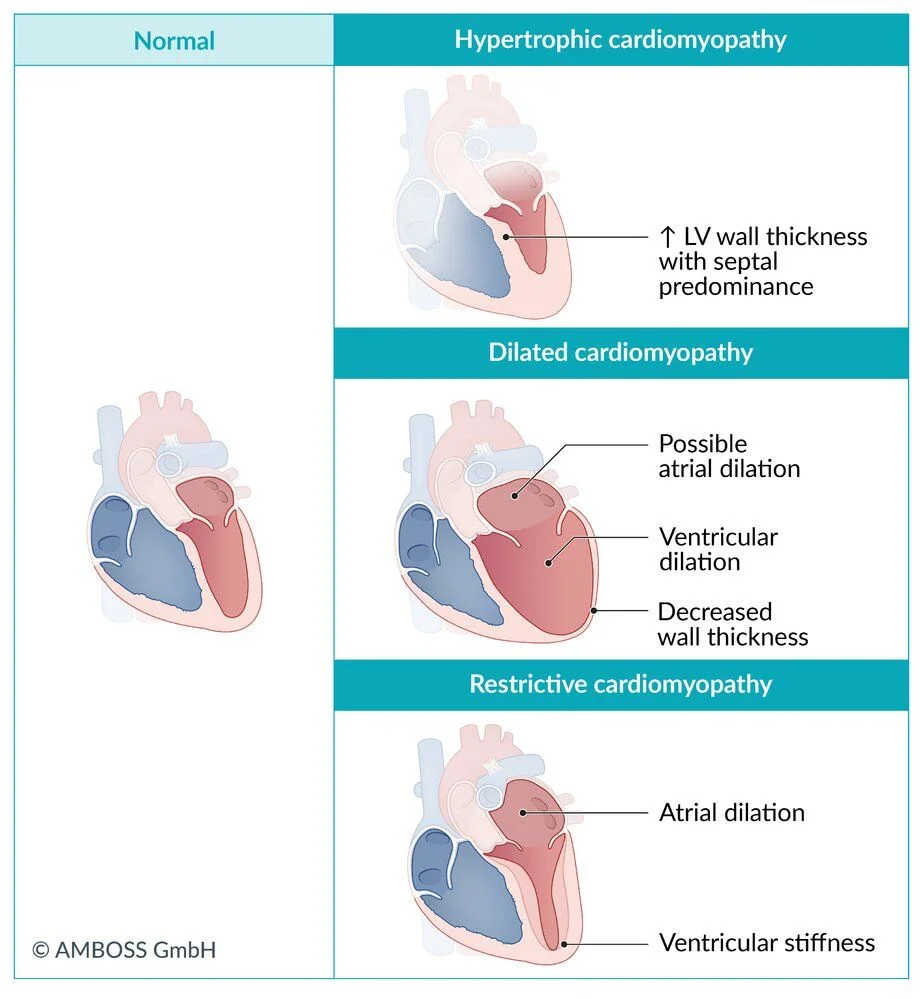 The three structural cardiomyopathies beside a normal heart. Hypertrophic: a thicker left ventricular wall with septal predominance. Dilated: ventricular dilation with thin walls and possible atrial dilation. Restrictive: stiff ventricles with dilated atria.