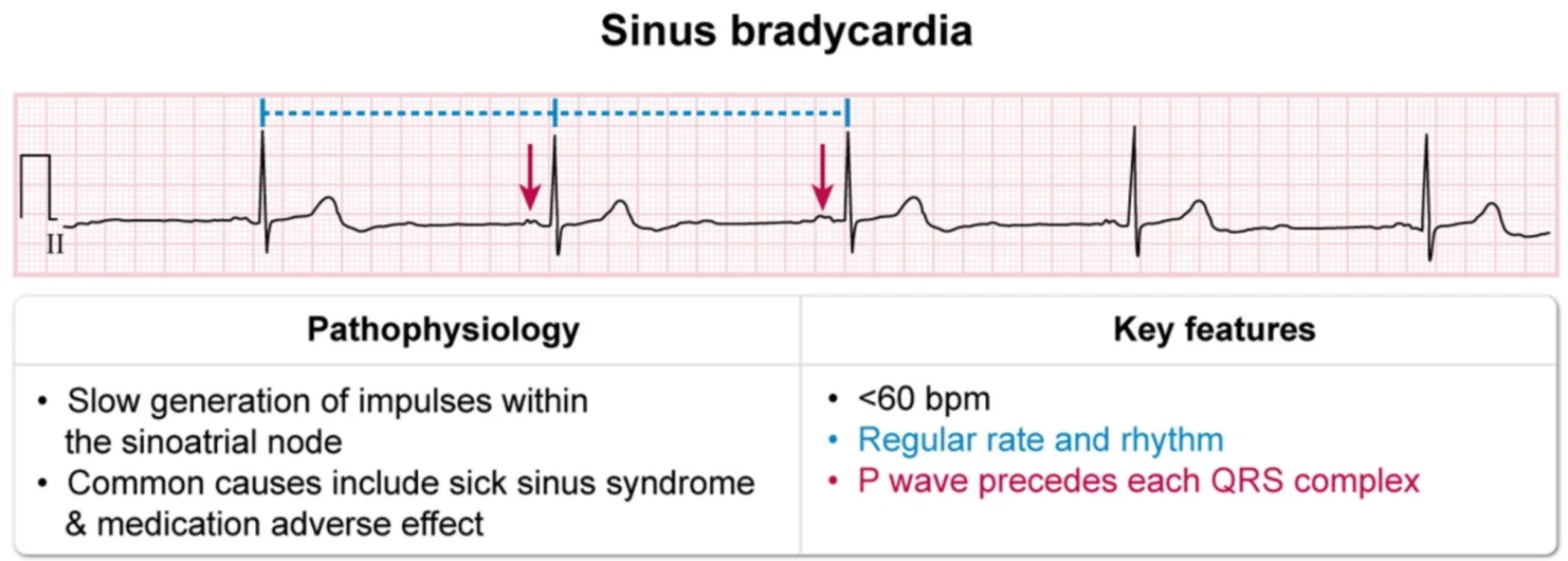 Sinus bradycardia: a regular rhythm under 60 per minute with a P wave before every QRS, from slow firing of the sinoatrial node (sick sinus syndrome, drug effects).