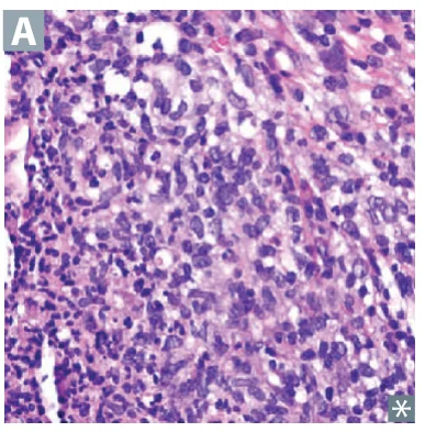 Acute inflammation: neutrophil-rich infiltrate.