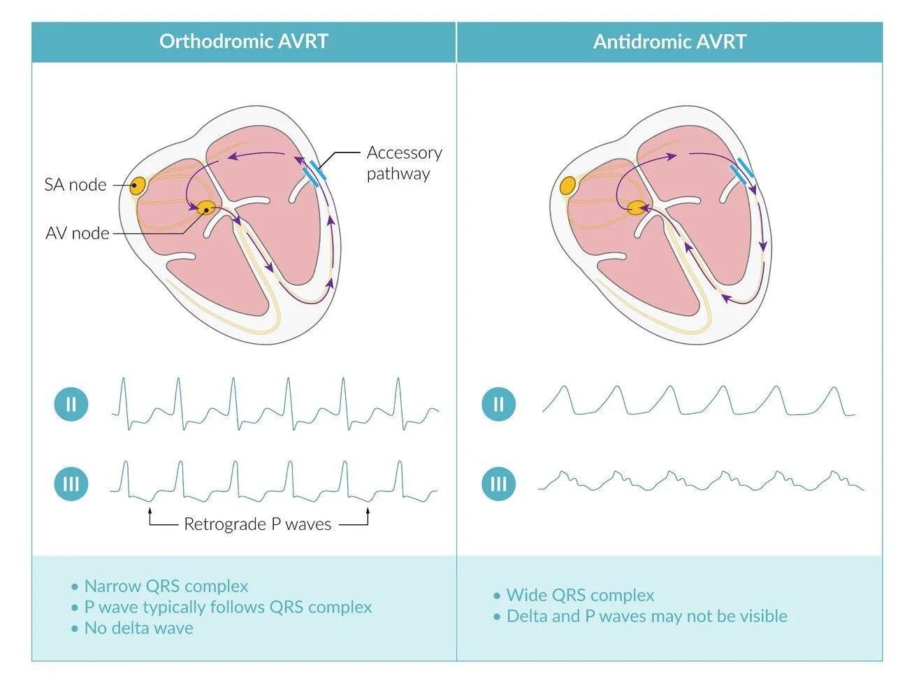 Orthodromic versus antidromic AVRT: orthodromic goes down the AV node and back up the accessory pathway (narrow QRS, P wave after the QRS, no delta wave); antidromic goes down the pathway and back up the node (wide QRS; delta and P waves may not be visible).