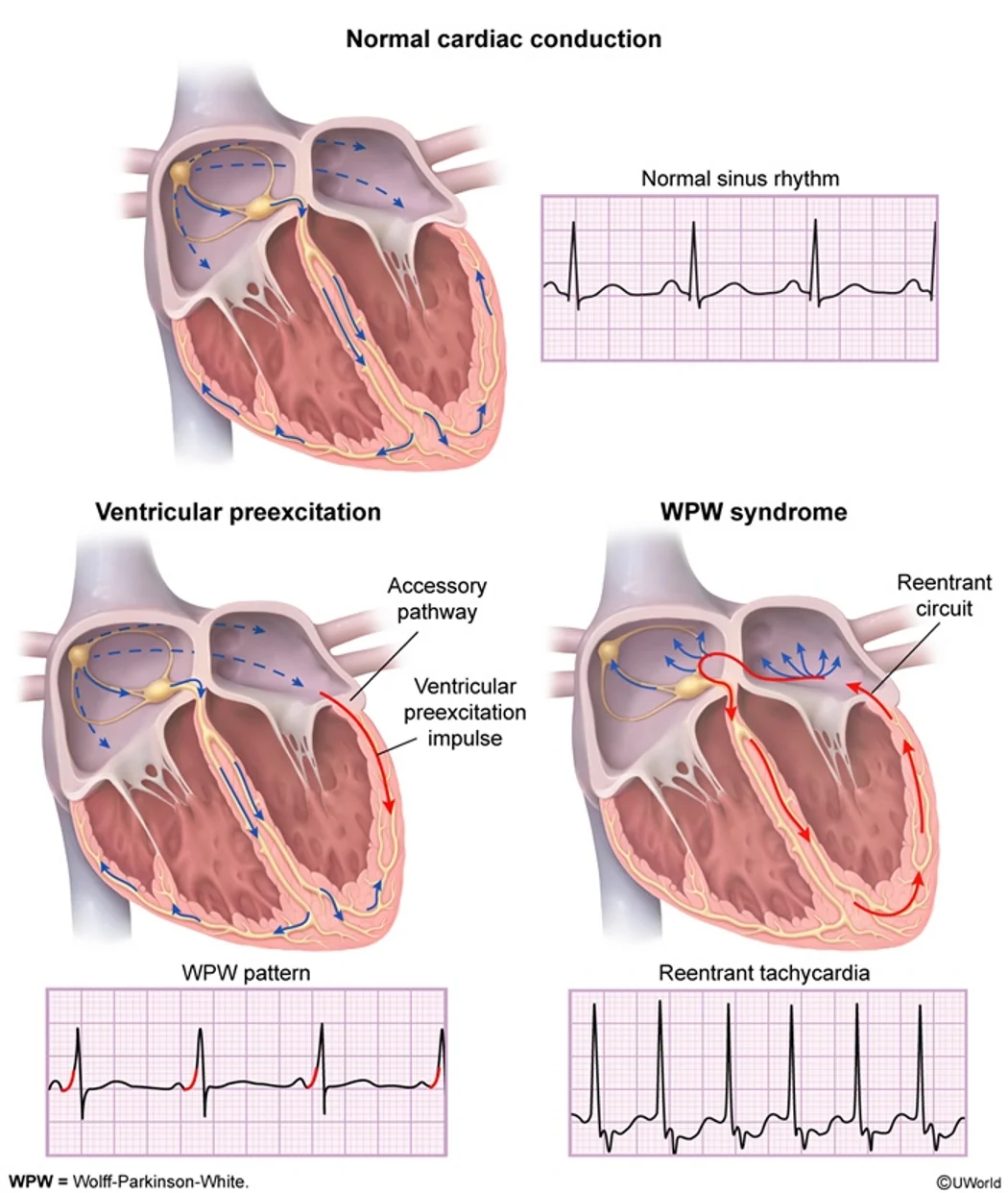 Normal conduction versus pre-excitation: in the WPW pattern the accessory pathway lets the impulse reach the ventricle early (a short PR and a delta wave); in WPW syndrome the same pathway forms a re-entrant circuit with the AV node, giving a regular tachycardia.