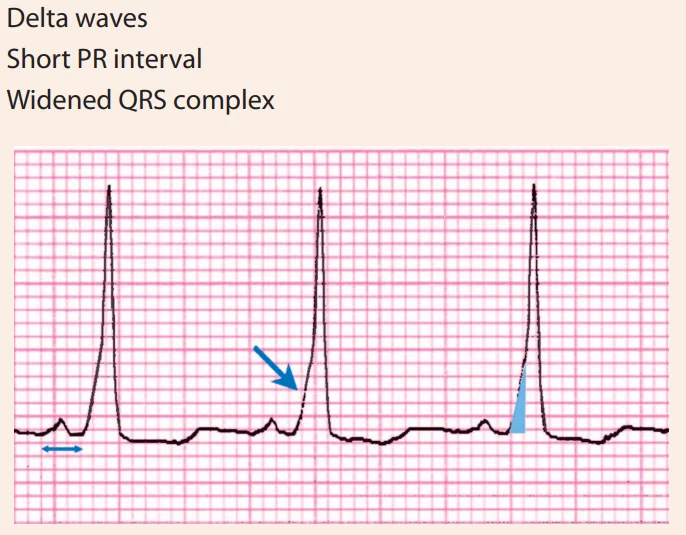 WPW pattern: a short PR interval (double arrow), a slurred upstroke at the start of the QRS (the delta wave, arrow), and a widened QRS.