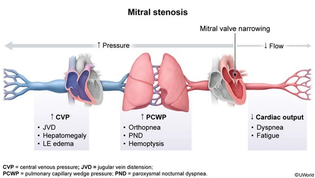 Mitral stenosis hemodynamics: the narrow valve raises pressure backward (left atrium, then the lungs, then the right heart) and lowers flow forward. High pulmonary capillary wedge pressure gives orthopnea, paroxysmal nocturnal dyspnea and hemoptysis; high central venous pressure gives jugular venous distension, hepatomegaly and leg edema; low cardiac output gives dyspnea and fatigue.