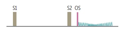 Mitral stenosis on a phonocardiogram: a loud S1, then after S2 an opening snap (OS) followed by a low-pitched mid-diastolic rumble. The shorter the gap between S2 and the opening snap, the tighter the valve.