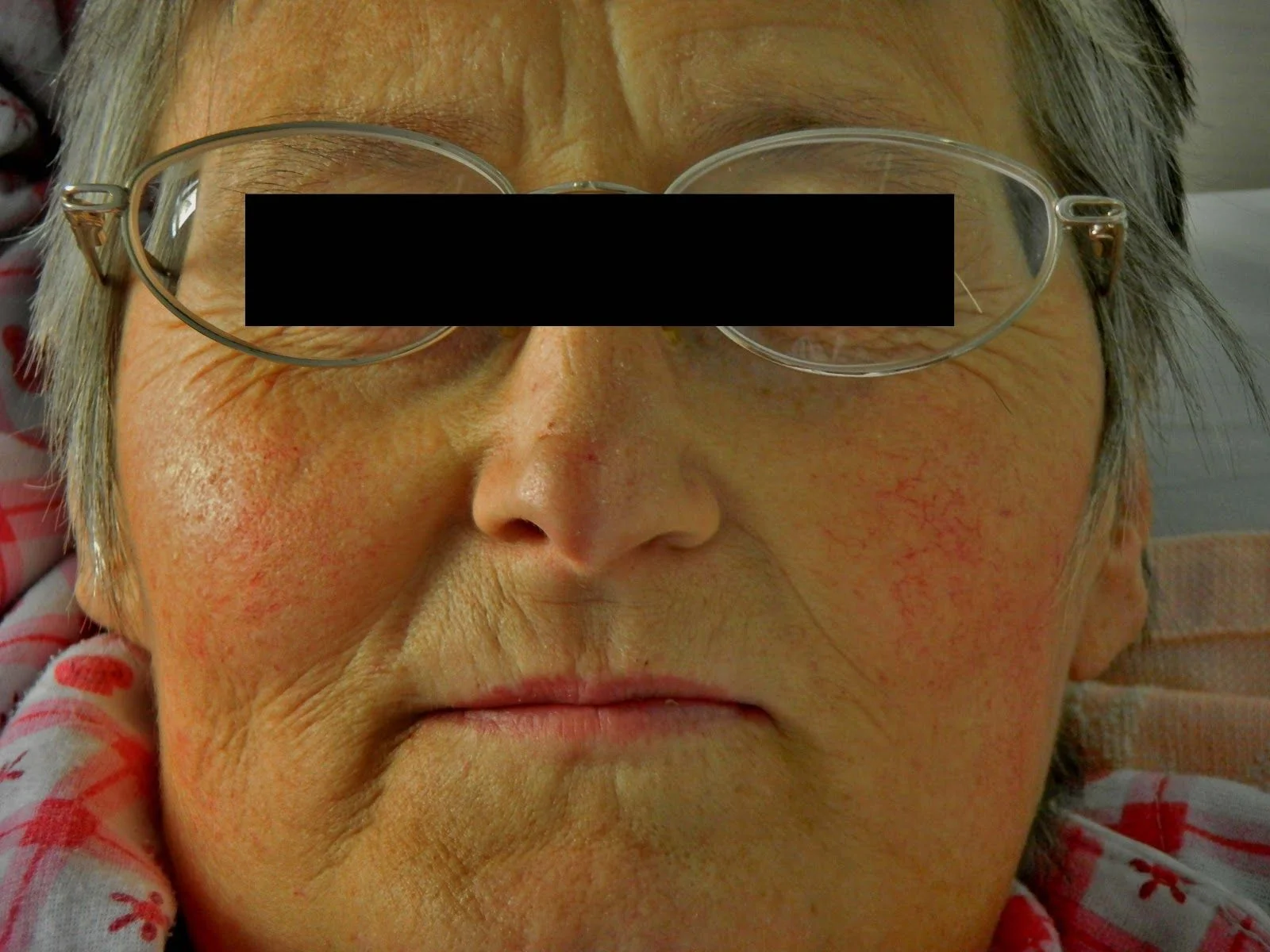 Mitral facies: pinkish-purple patches over the cheeks in a patient with mitral stenosis.