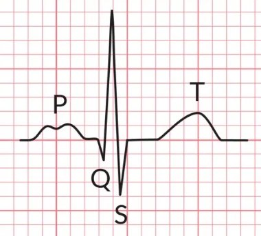P mitrale: a broad, notched (double-humped) P wave, the sign of left atrial enlargement in mitral stenosis.