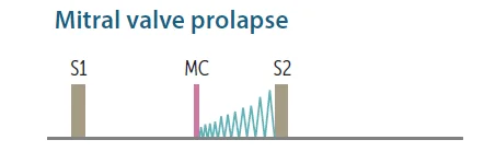 Mitral valve prolapse on a phonocardiogram: a mid-systolic click (MC) followed by a late systolic regurgitant murmur that builds up to S2.