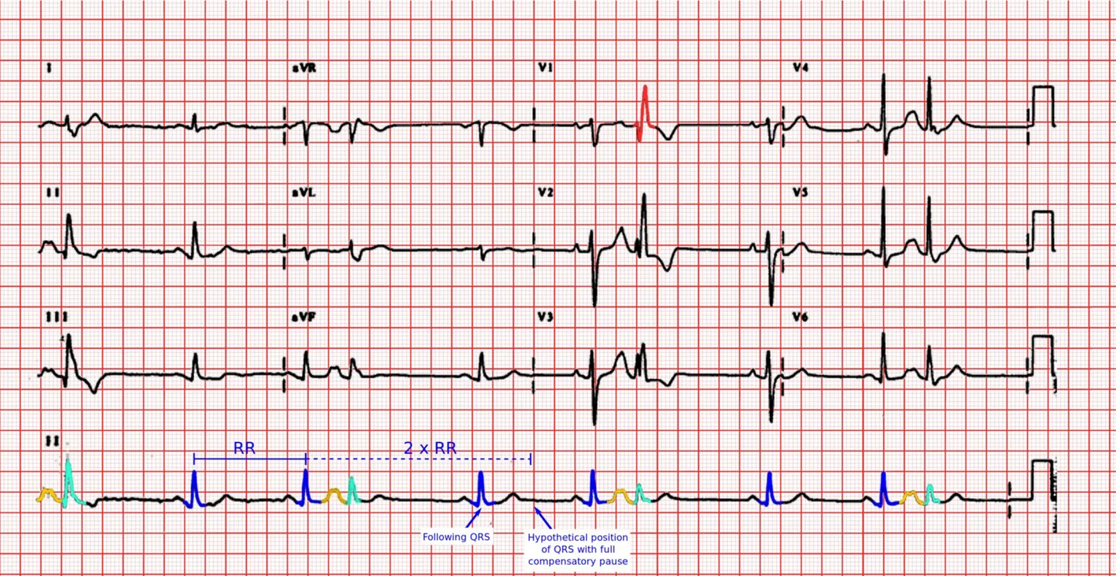 Premature atrial complexes on a 12-lead ECG: the early P wave can merge with the preceding T wave to give a larger, notched wave (best seen in rhythm strip II). The R-R interval around the early beat is shorter than twice the normal R-R, so the pause is not fully compensatory.