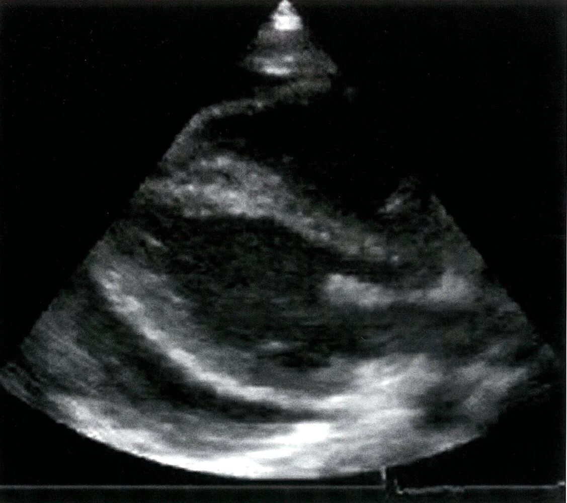 Pericardial effusion on echocardiography: a dark, echo-free space surrounding the heart between the two pericardial layers.