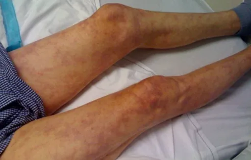 Livedo reticularis: a mottled, net-like purple discoloration of the legs after a vascular procedure.