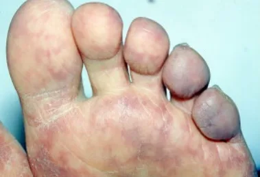 Blue toe syndrome: cyanotic, painful toes while the foot pulses stay palpable, because only the small arteries are blocked.