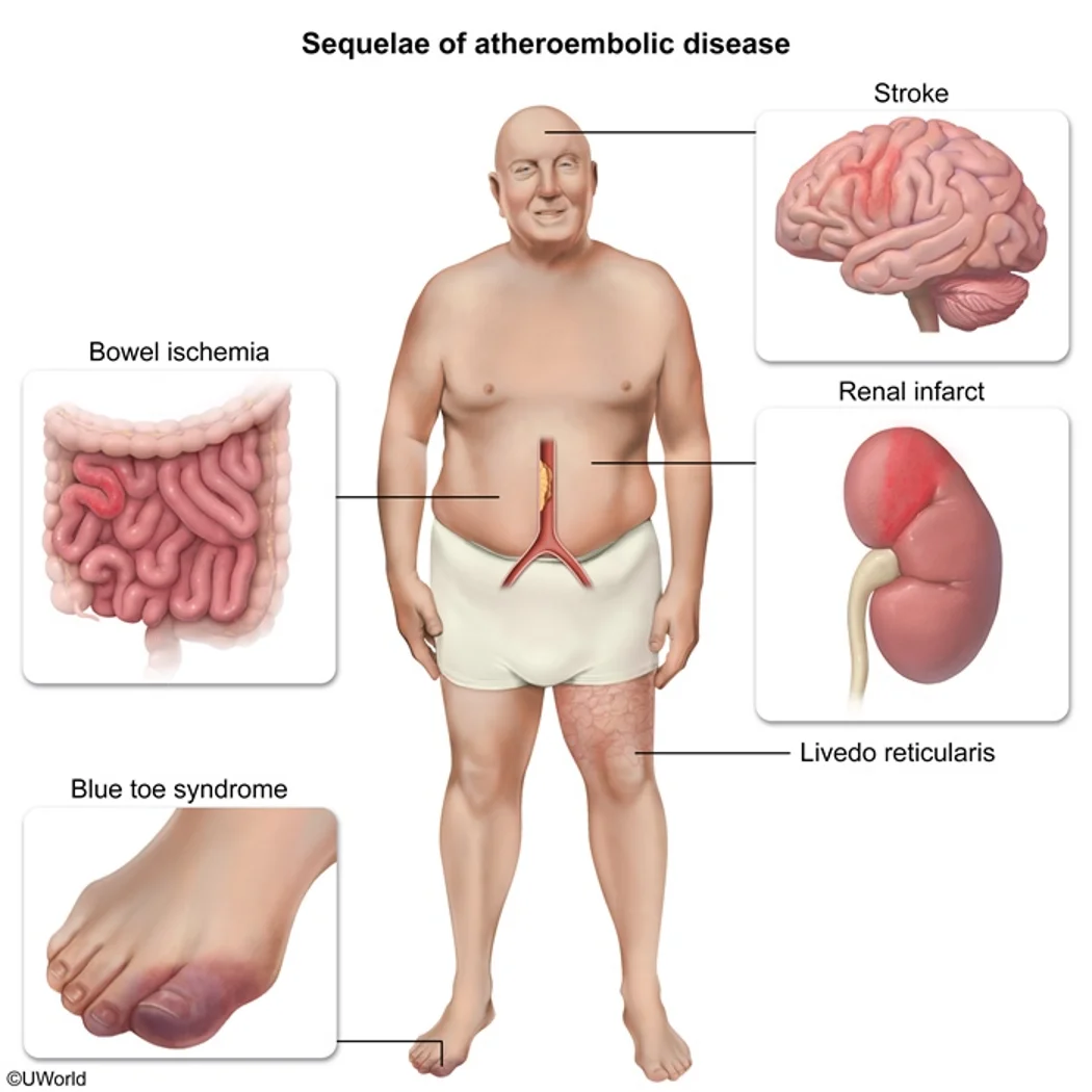 Where atheroemboli land: debris from an aortic plaque showers the brain (stroke), kidneys (renal infarct and acute kidney injury), bowel (ischemia), the skin of the legs (livedo reticularis) and the toes (blue toe syndrome).