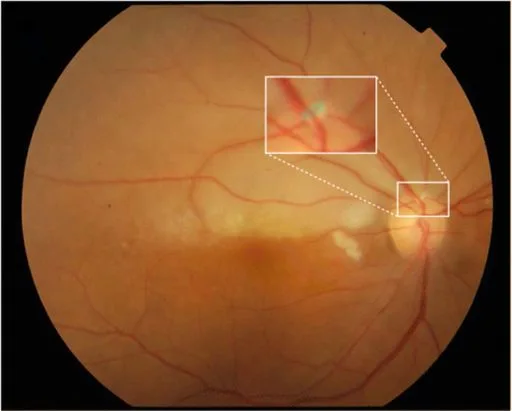 Hollenhorst plaque: a bright, yellow, refractile cholesterol plaque lodged at a retinal artery branch point (boxed), causing a branch retinal artery occlusion.
