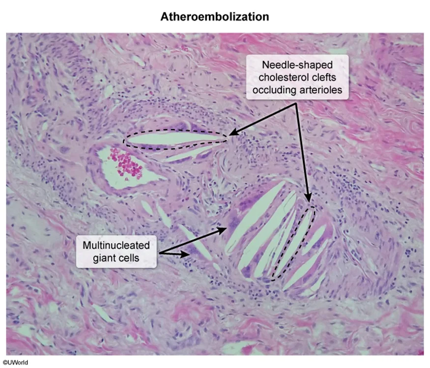 Atheroembolization on biopsy: empty, needle-shaped cholesterol clefts (the crystals dissolve during processing) occluding small arterioles, surrounded by multinucleated giant cells.
