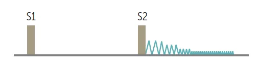 Aortic regurgitation murmur: a blowing decrescendo murmur that starts right after S2, loudest at the beginning of diastole, and fades before S1.