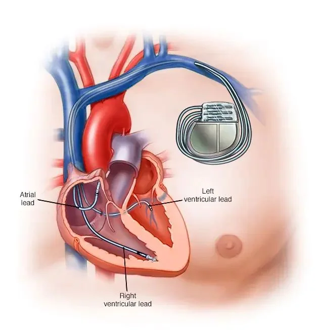 Cardiac resynchronization therapy: an atrial lead, a right ventricular lead, and a left ventricular lead placed through the coronary sinus, so both ventricles contract together.