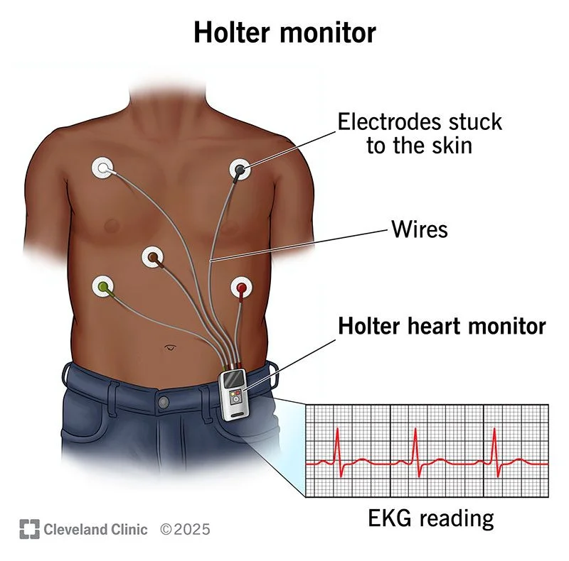 Holter monitor: skin electrodes wired to a small recorder worn on the belt, recording a continuous ECG for 1 to 2 days.