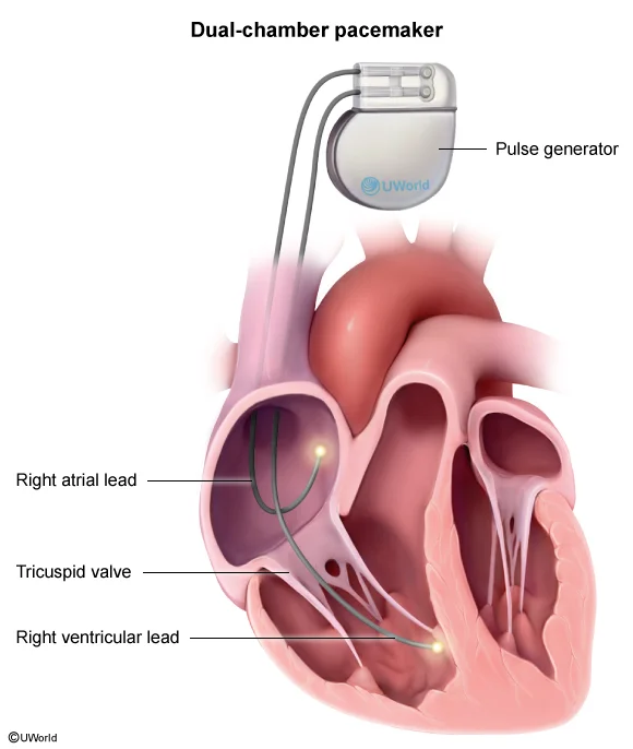 Dual-chamber pacemaker: a pulse generator with a right atrial lead and a right ventricular lead. The ventricular lead crosses the tricuspid valve, which is how it can cause tricuspid regurgitation.