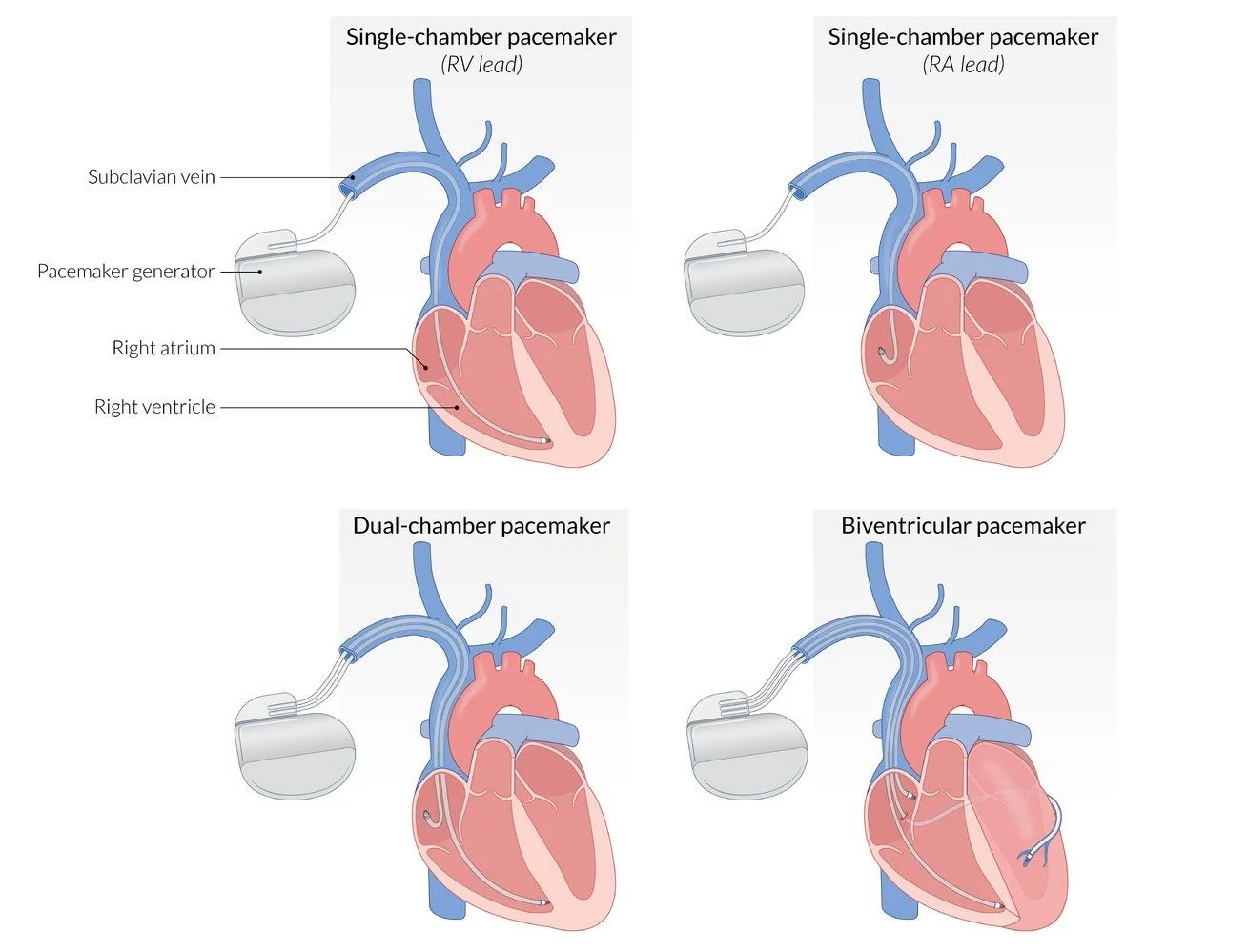 Pacemaker types: single-chamber with a right ventricular lead or a right atrial lead, dual-chamber with one lead in each, and biventricular with an extra lead to the left ventricle. The generator sits under the skin below the clavicle, with leads through the subclavian vein.