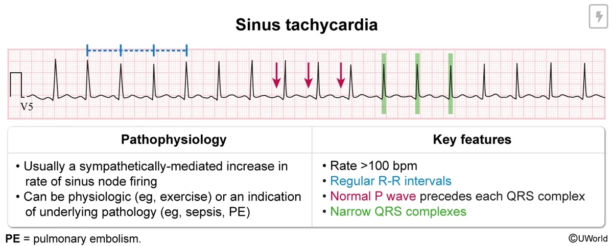Sinus tachycardia: a regular rhythm over 100 per minute with a normal P wave before every narrow QRS. It is usually a sympathetic response to an underlying problem (sepsis, pulmonary embolism) or to normal physiology (exercise).