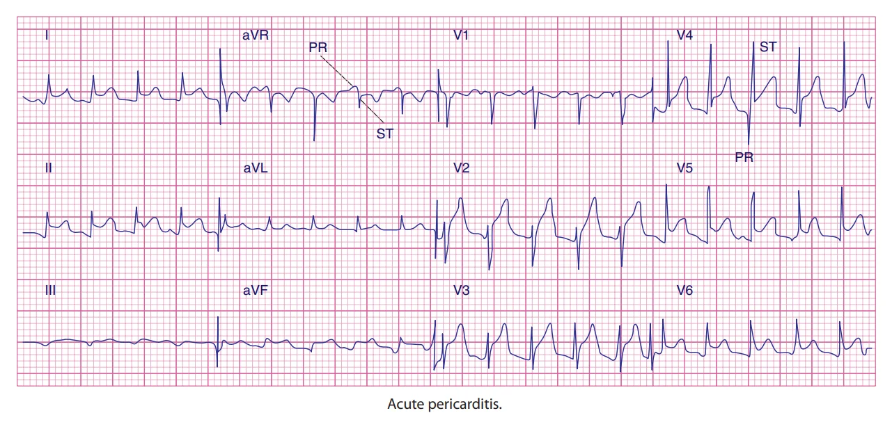 Acute pericarditis on a 12-lead ECG: concave ST elevation across many leads that do not belong to one coronary territory, with PR-segment depression (labelled PR and ST), and no reciprocal ST depression except in aVR.