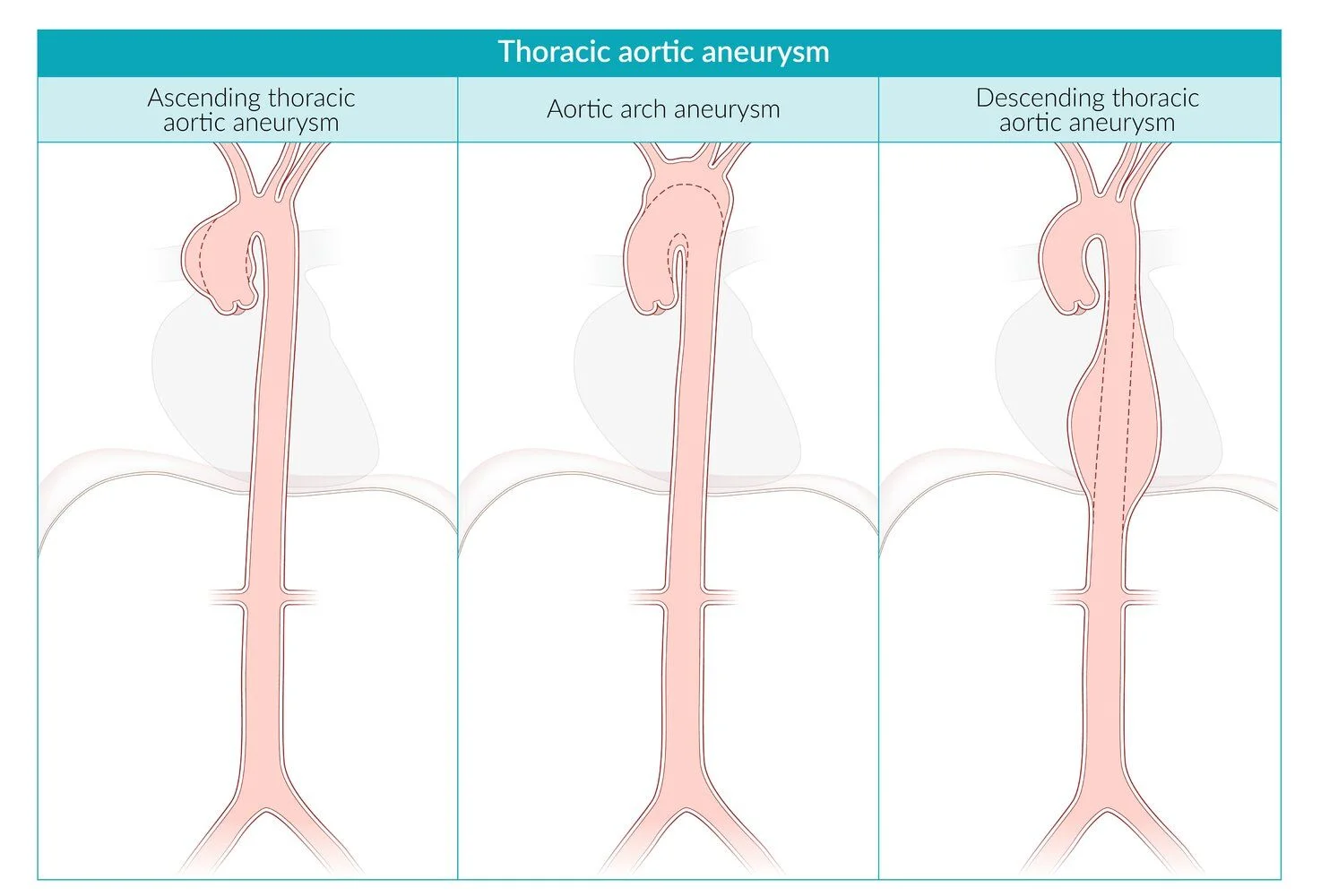 Thoracic aortic aneurysm by segment: ascending aortic aneurysm, aortic arch aneurysm and descending thoracic aortic aneurysm.