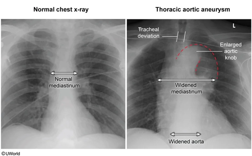 Normal chest radiograph beside a thoracic aortic aneurysm: the aneurysm widens the mediastinum and aorta, enlarges the aortic knob and pushes the trachea aside.