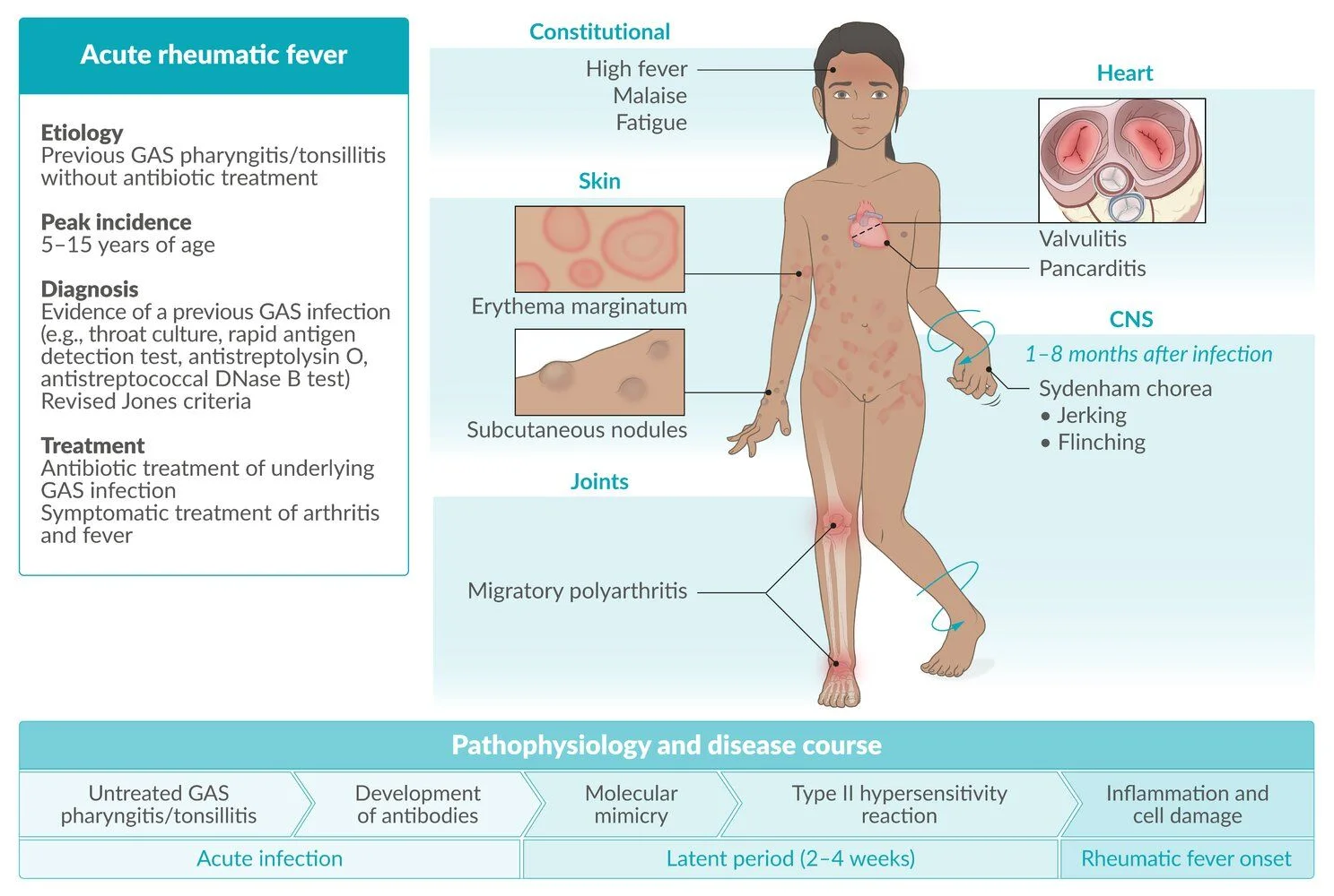 Acute rheumatic fever at a glance: untreated GAS pharyngitis is followed by a latent period of about 2 to 4 weeks, when antibodies against the streptococcus cross-react with the body (molecular mimicry, a type II hypersensitivity reaction). The major features are pancarditis with valvulitis, erythema marginatum, subcutaneous nodules, migratory polyarthritis of the large joints, and Sydenham chorea, which can appear months after the infection.