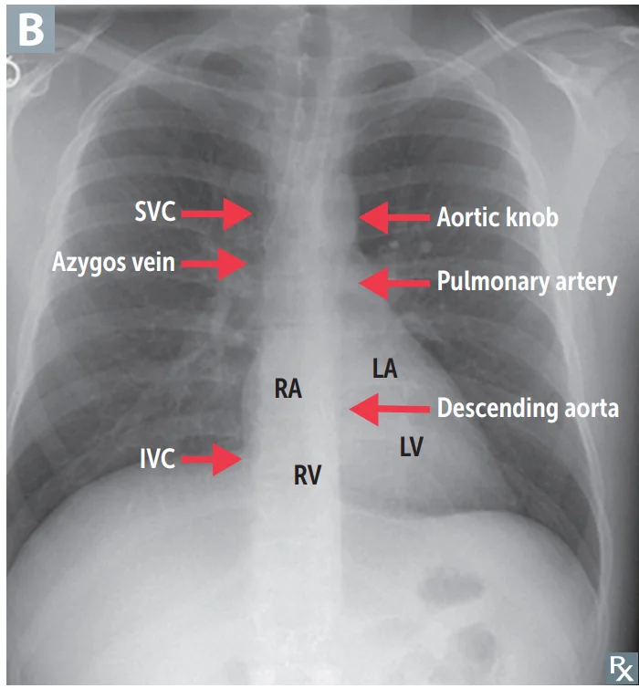 Frontal chest radiograph with the mediastinal borders labelled. Right side, top to bottom: superior vena cava, azygos vein, right atrium, inferior vena cava. Left side: aortic knob, pulmonary artery, then the left atrial appendage region and the left ventricle. The right ventricle sits in front and forms the inferior border; the descending aorta runs behind the heart.