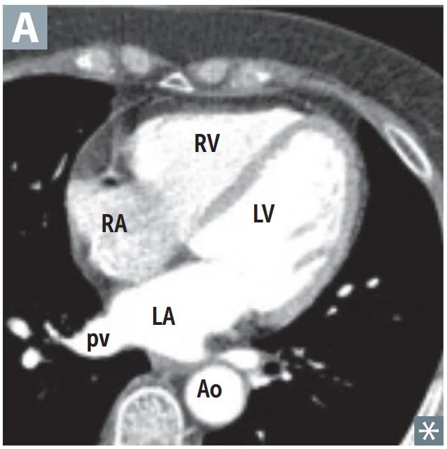 Contrast CT, four-chamber view. The right ventricle (RV) is the front-most chamber, just behind the sternum. The left atrium (LA) is the back-most chamber, receiving the pulmonary veins (pv) and sitting directly in front of the descending aorta (Ao) and the esophagus. RA, right atrium; LV, left ventricle.