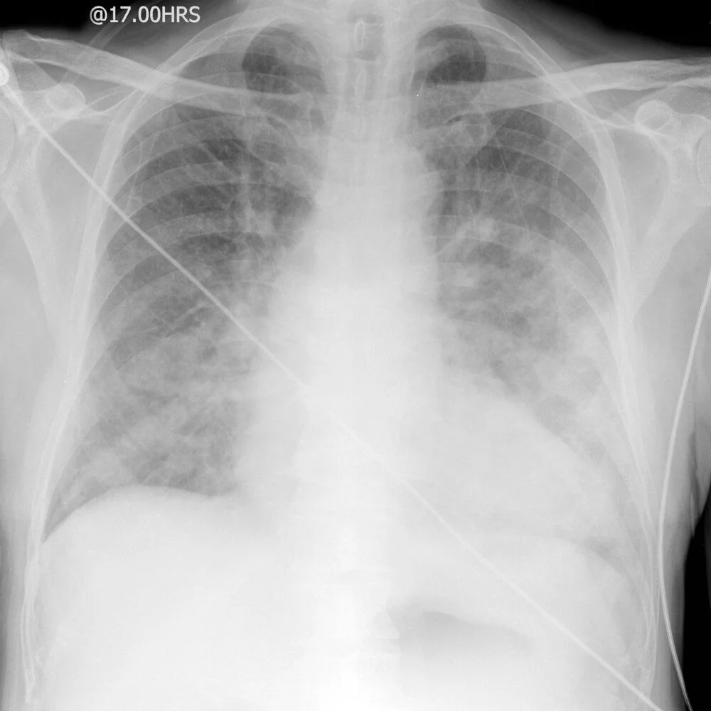 Cardiogenic pulmonary edema on a frontal chest film: an enlarged heart shadow, prominent pulmonary vessels and hazy perihilar alveolar edema spreading out from both hila (the bat-wing pattern), with basal interstitial edema.