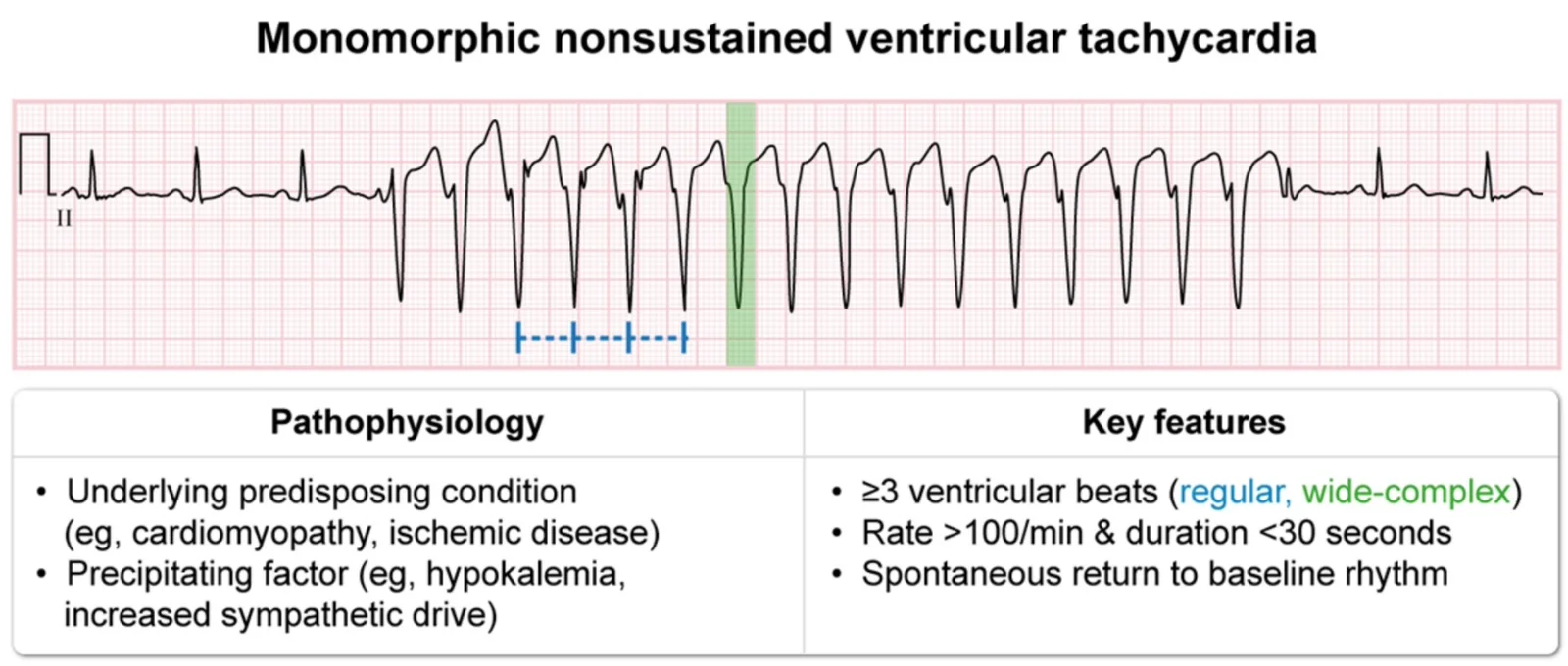 Non-sustained monomorphic VT: a run of 3 or more regular wide complexes over 100 per minute that stops on its own within 30 seconds. There is usually an underlying condition (cardiomyopathy, ischemia) or a trigger (hypokalemia, high sympathetic drive).