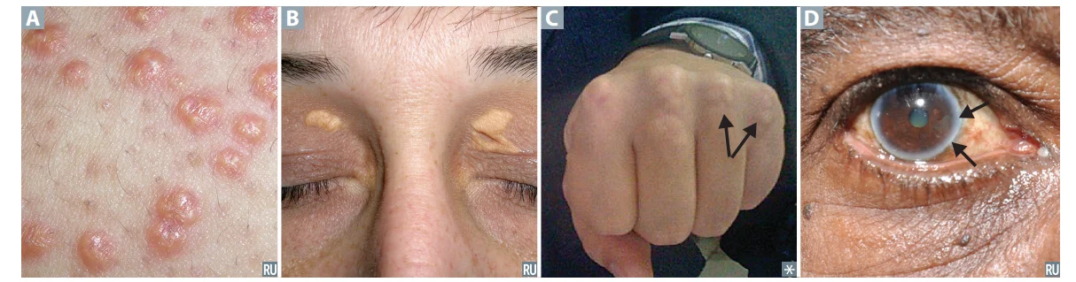 The physical clues of inherited dyslipidemia. (A) Eruptive xanthomas, crops of small yellow papules with very high triglycerides. (B) Xanthelasma, lipid plaques on the eyelids. (C) Tendon xanthomas over the finger extensor tendons (arrows), the sign of familial hypercholesterolemia. (D) Corneal arcus, a lipid ring at the edge of the cornea, significant when it appears at a young age.