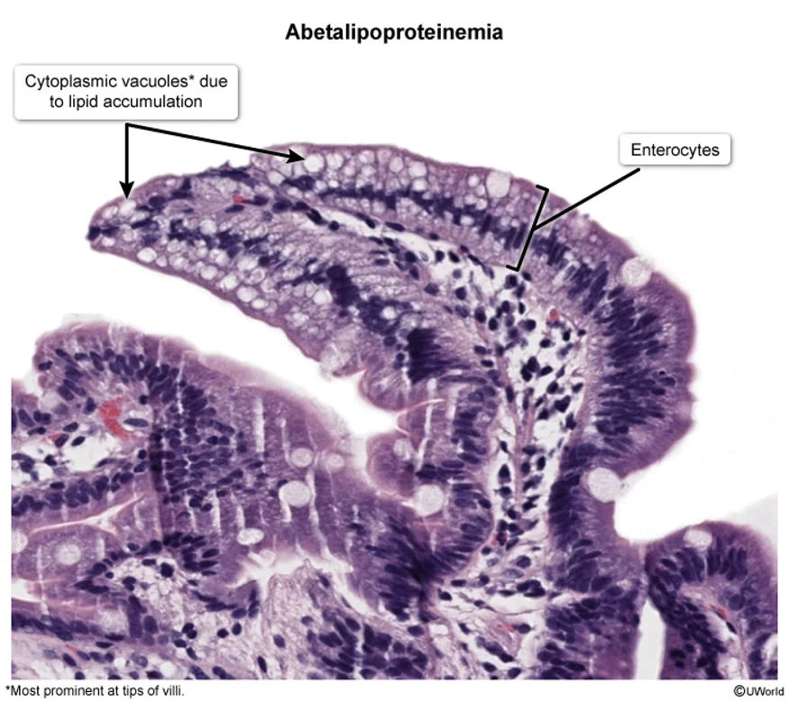 Abetalipoproteinemia on small-bowel biopsy: the enterocytes lining the villus are pale and foamy with cytoplasmic vacuoles of trapped lipid, most prominent at the tips of the villi, because the fat cannot be packaged into chylomicrons and exported.