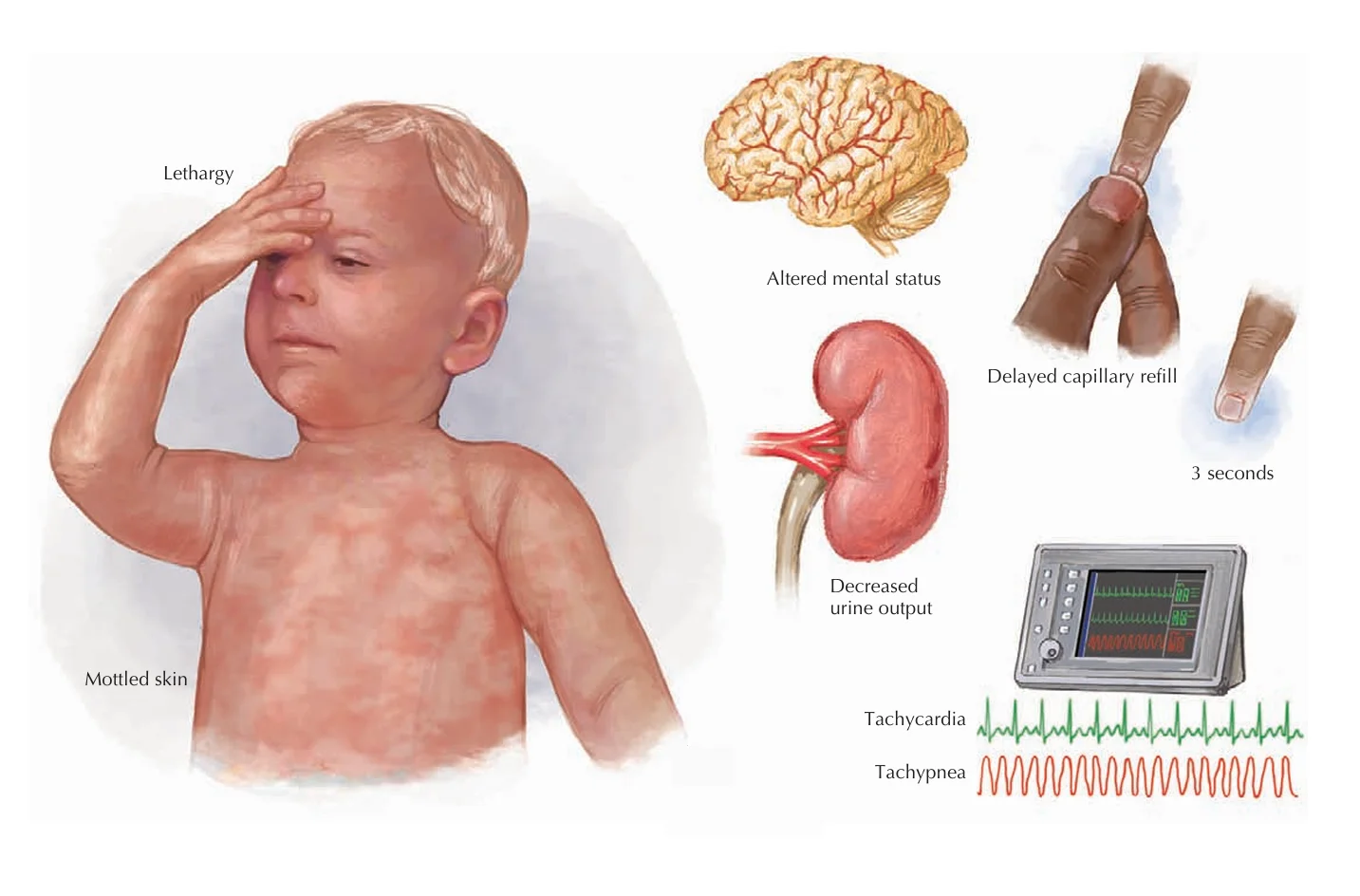Signs of shock in a child: lethargy and altered mental status, mottled skin, a capillary refill over 3 seconds, low urine output, tachycardia and tachypnea.