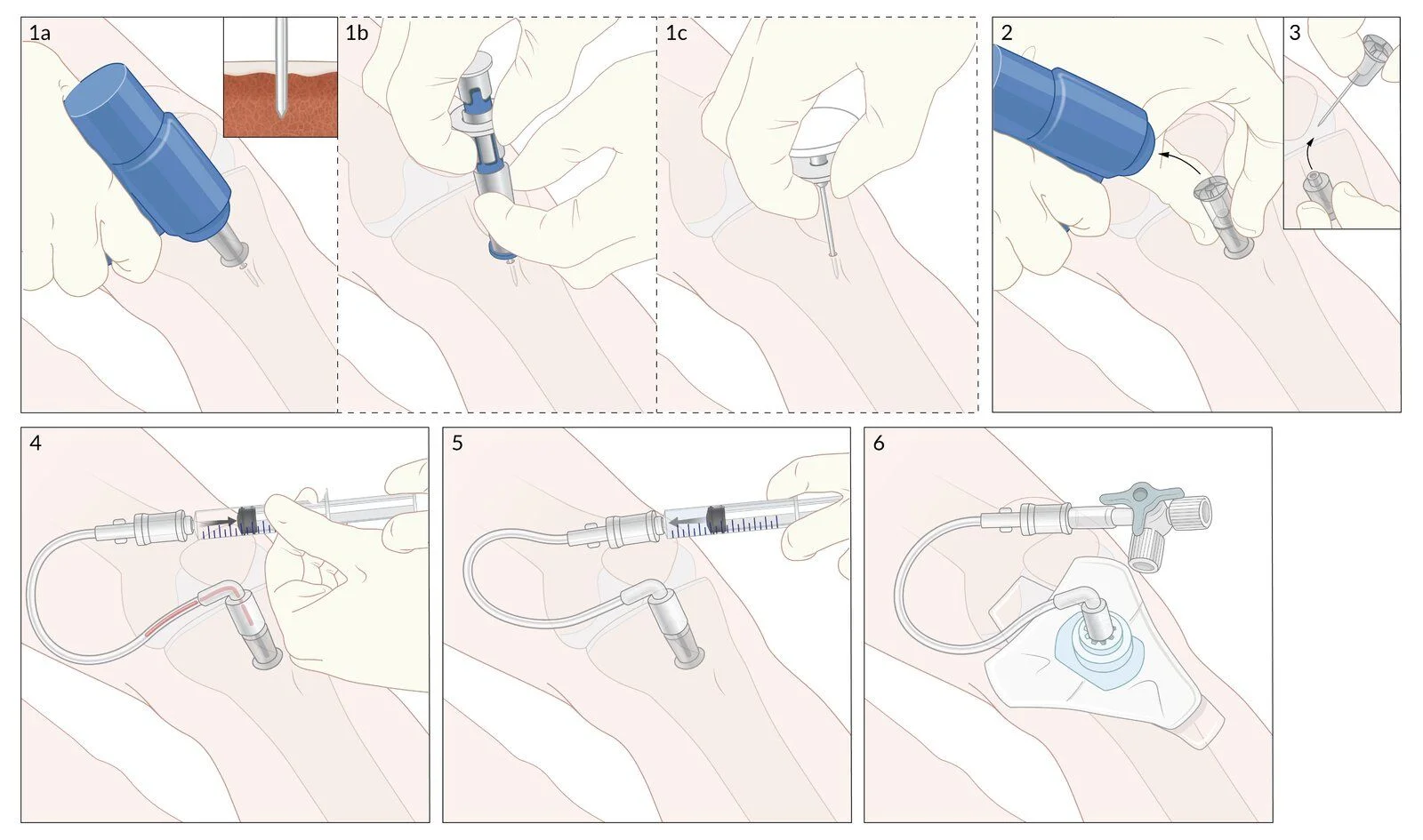 Intraosseous access step by step: locate the proximal tibia below the tibial tuberosity, drive the needle into the marrow cavity with a powered driver, remove the stylet, confirm placement and connect the infusion line.